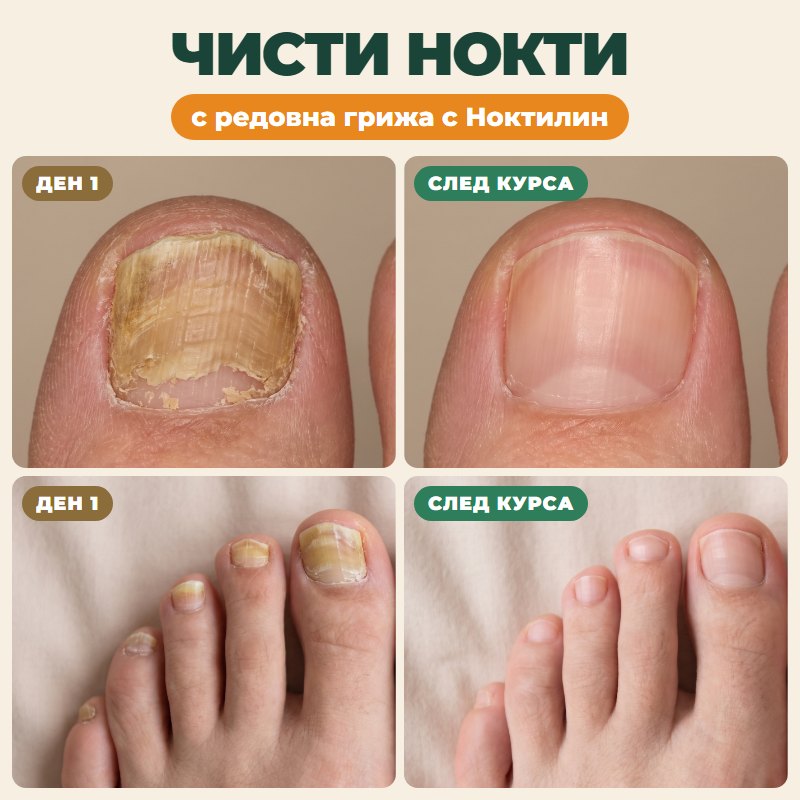 НОКТИЛИН — чисти нокти